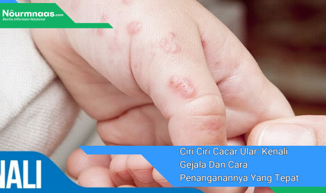 Ciri Ciri Cacar Ular: Kenali Gejala Dan Cara Penanganannya Yang Tepat